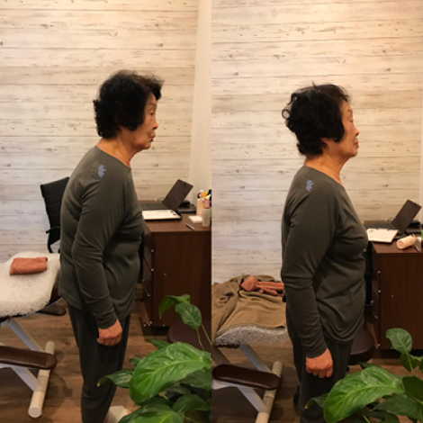 施術前後の比較 事例1：肩こり・猫背改善