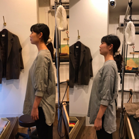 施術前後の比較 事例2：骨盤の歪み・姿勢改善